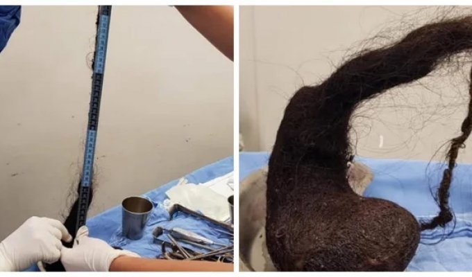 She lost weight and suffered from depression: doctors found a huge hairball in the stomach of a three-year-old girl (3 photos)