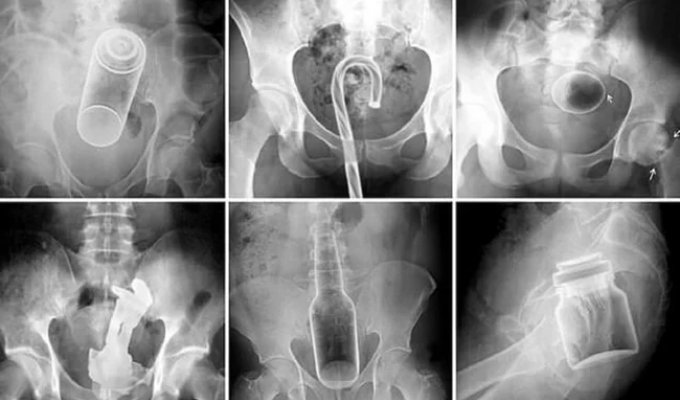 Experts compiled a ranking of things that got stuck in people's orifices in 2025 (5 photos)